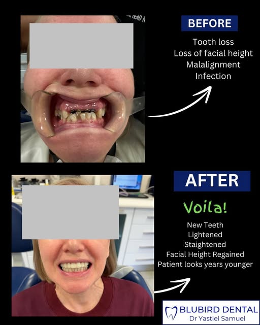 Before and after result of a full smile makeover addressing tooth loss, malalignment and infection