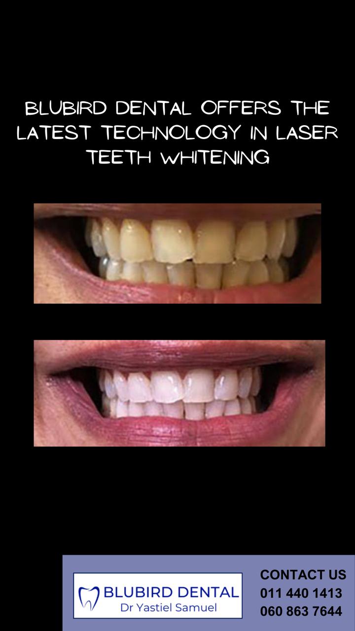 Before and after Zoom! teeth whitening result